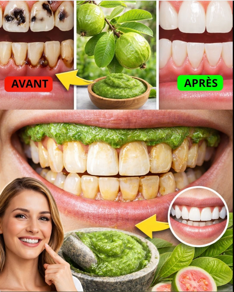 Découvrez le secret de la nature : 3 remèdes puissants avec des feuilles de goyave pour lutter contre les caries dentaires