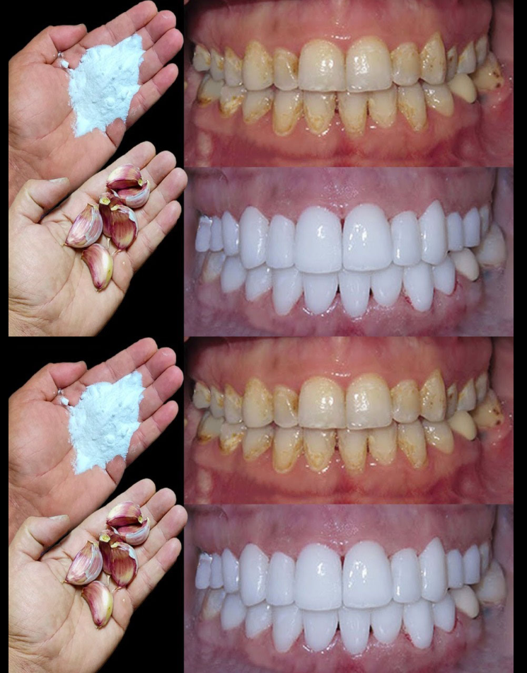 Comment blanchir les dents en 2 minutes ?