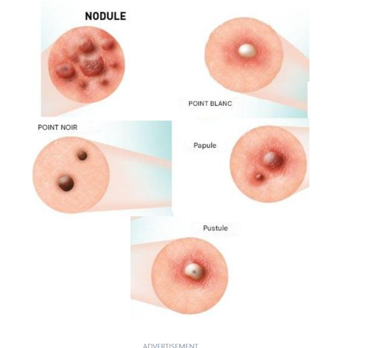 Remèdes naturels pour traiter les taches de vieillesse, les grains de beauté, les acrochordons, les verrues et les points noirs