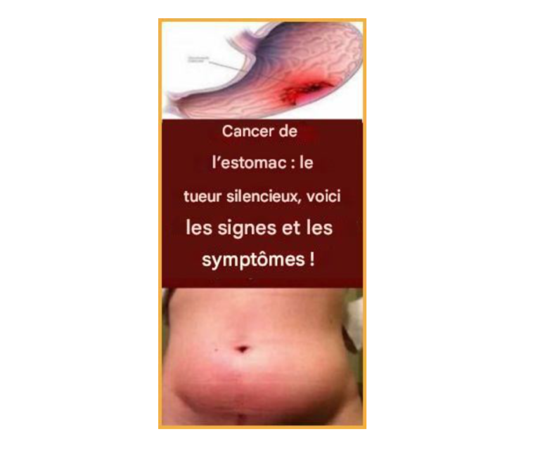 CANCER DE L'ESTOMAC LE TUEUR SILENCIEUX, voici les signes et symptômes !