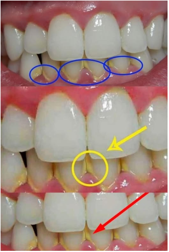 Enlevez la Plaque Dentaire dans 5 minutes Naturellement, sans Aller au Dentiste